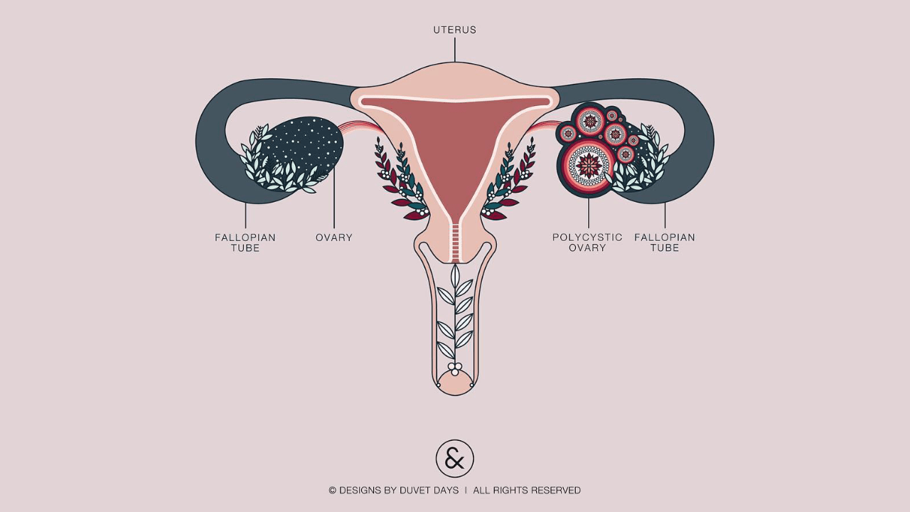 Food & PCOS – The Thought Co.